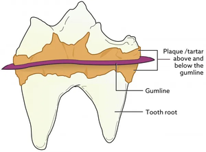 Dental calculus 